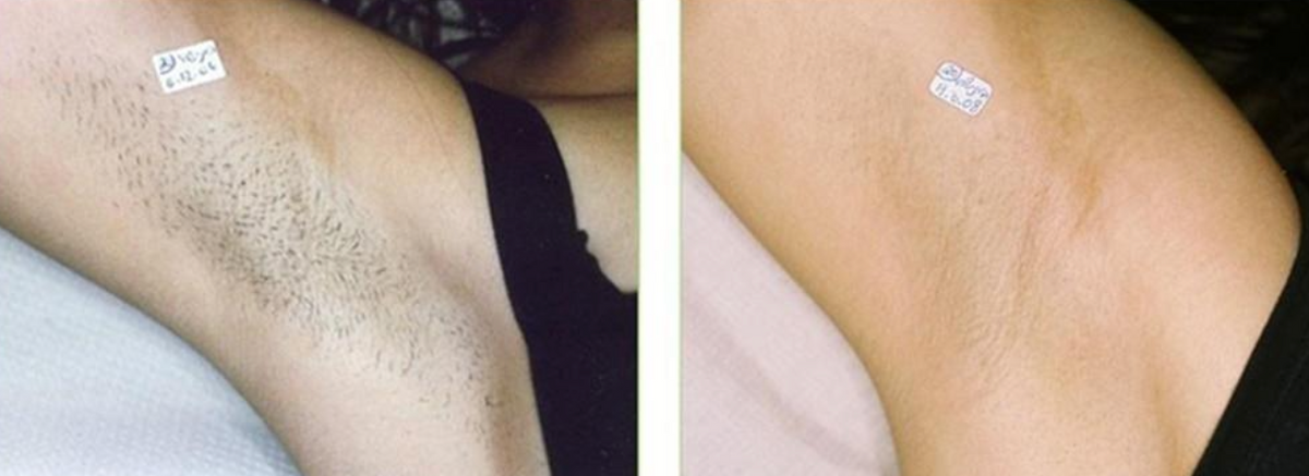 Skyline Hair Removal Companion - Sunny Skyline